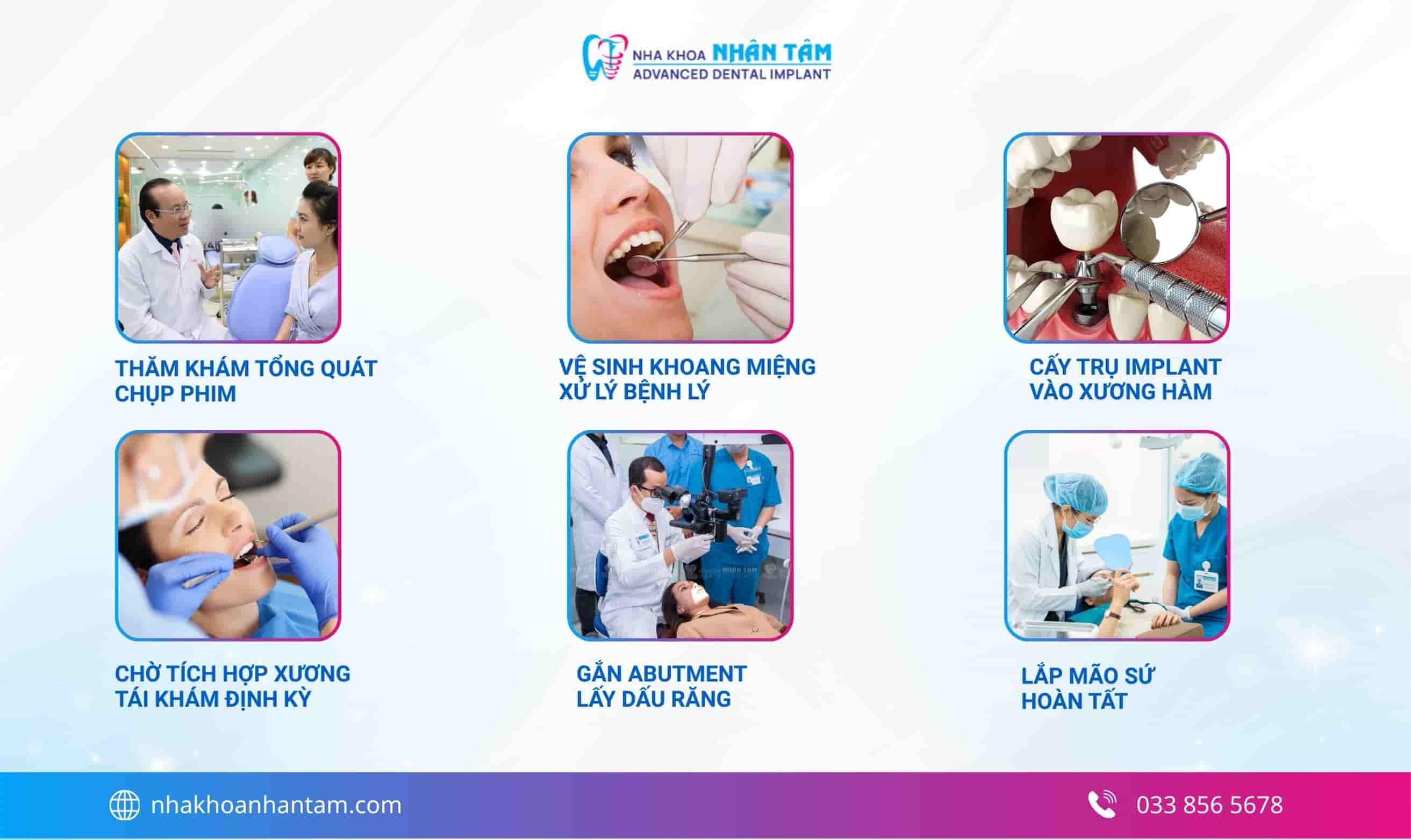 Quy trình trồng răng Implant chuẩn y khoa